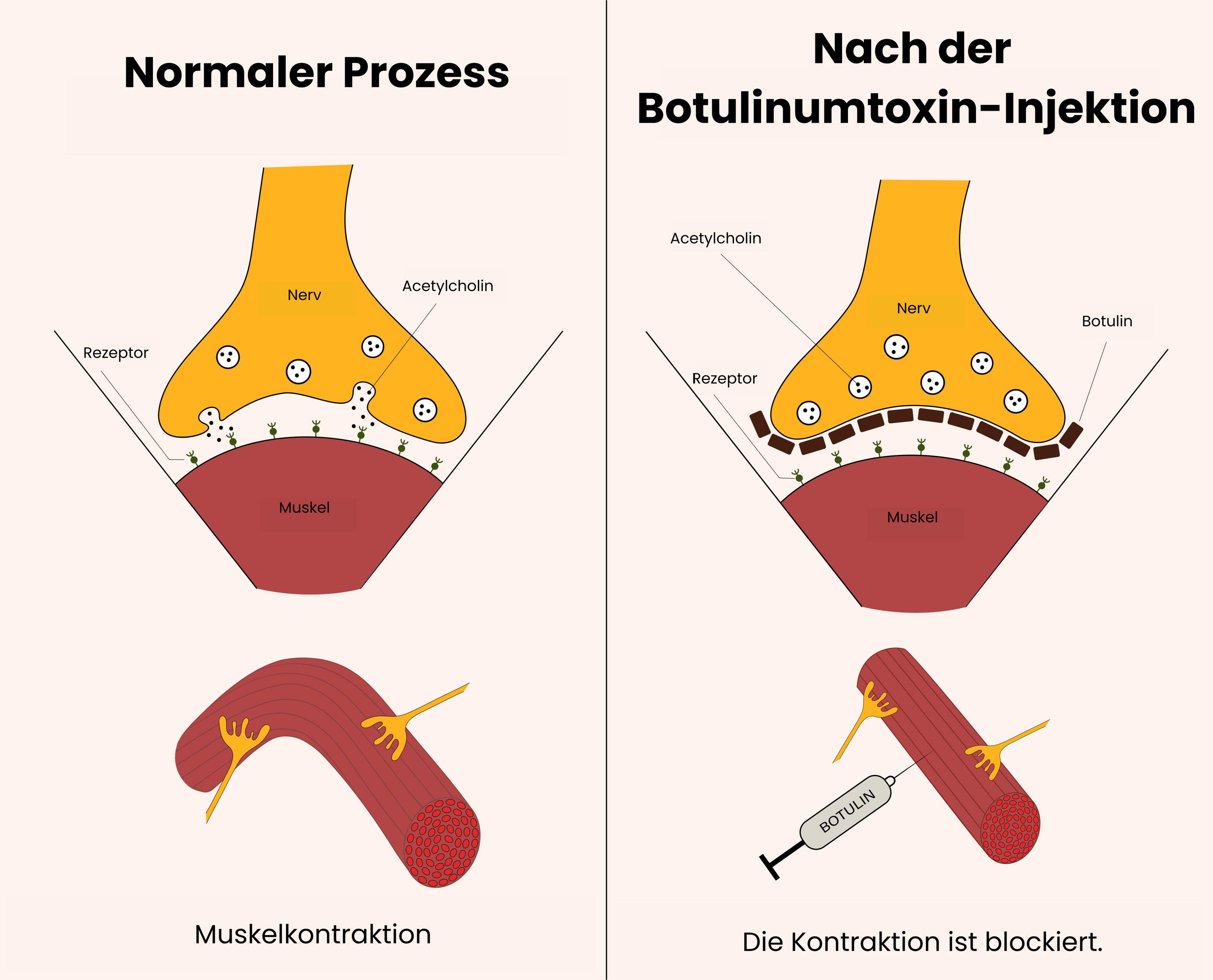 Die Infografik zeigt, wie Botox die Freisetzung von Neurotransmittern hemmt und so Muskelkontraktionen verhindert.